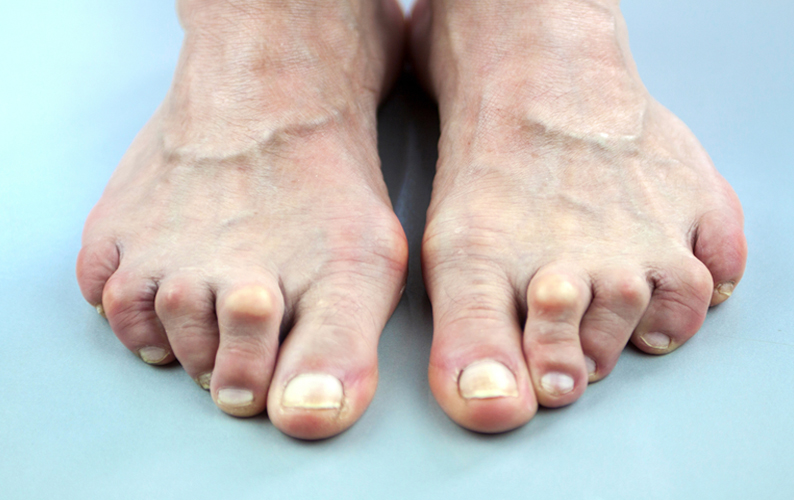 Arthritis and your feet.