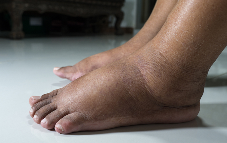 Diabetes and your feet.