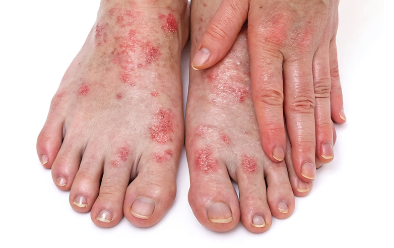 skin disorders on feet